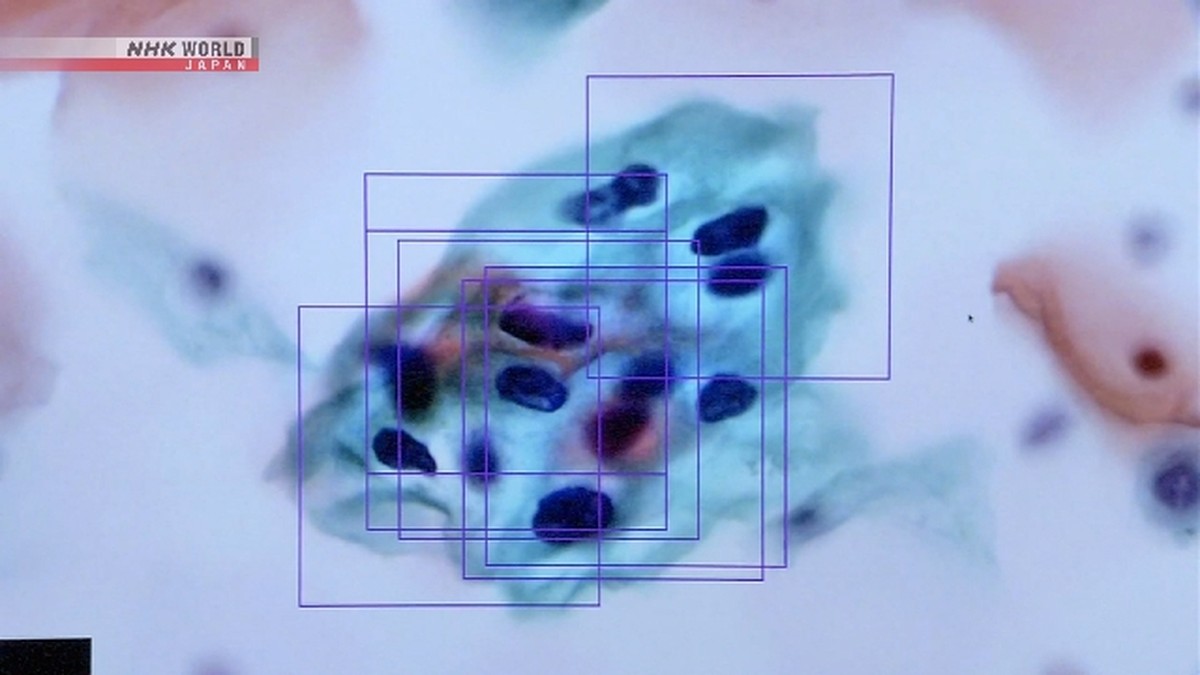 AI Analisis Gambar 3D untuk Bantu Peneliti Deteksi Sel Kanker Serviks