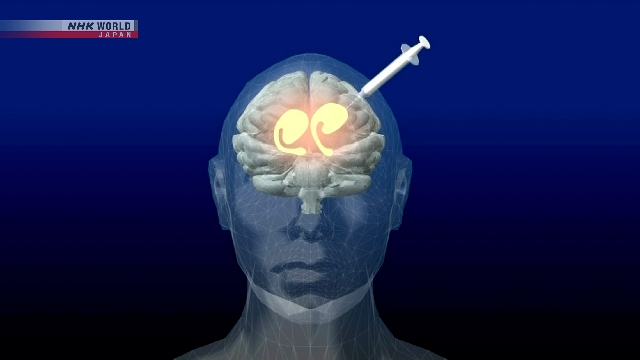 Ilustrasi sel punca iPS yang digunakan untuk terapi medis penyakit Parkinson di Jepang.